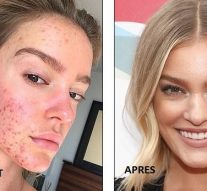 Une femme de 24 ans qui a dépensé plus de 15 000 dollars pour tenter de guérir son acné résout enfin le problème avec un régime alimentaire spécial et des toniques à base de plantes